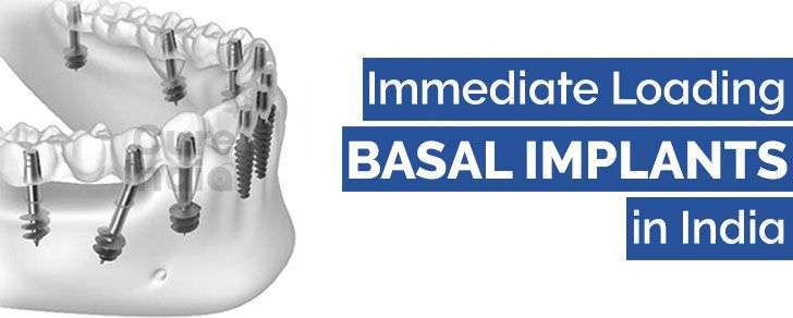 Immediate-3 days Implants